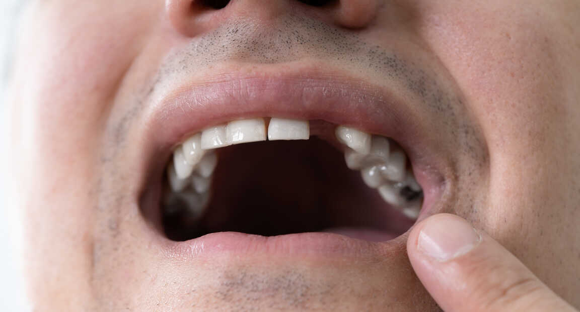 Összefüggés a fogak elvesztése és a vesebetegség között