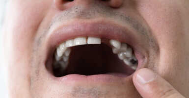 Összefüggés a fogak elvesztése és a veyebetegség között