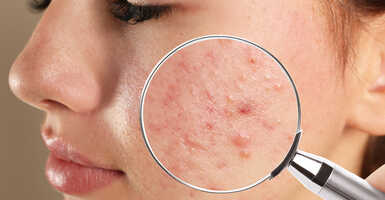 Aknés bőr kezelése bőrgyógyásszal